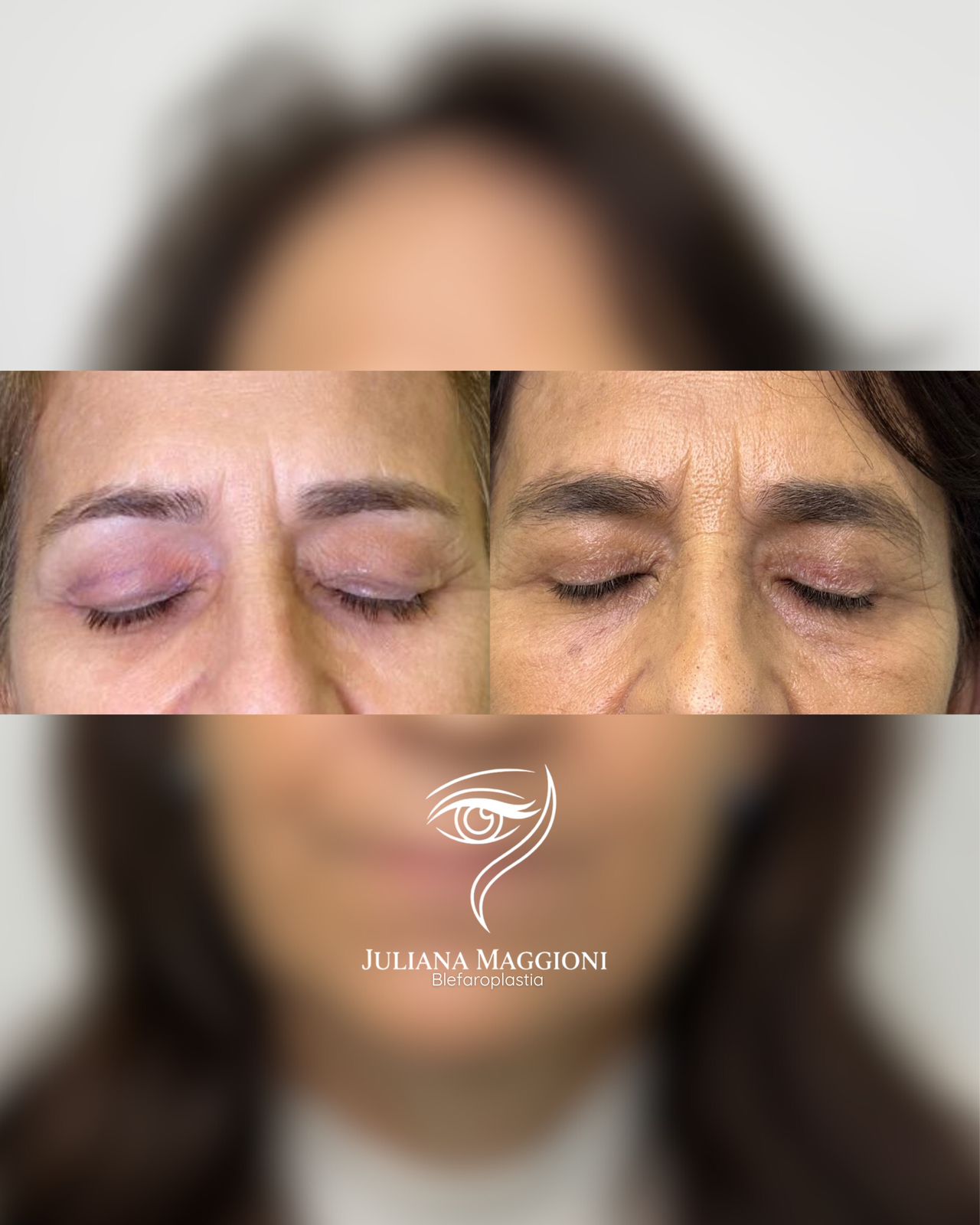 Antes e depois cirurgia das pálpebras em Dois Vizinhos